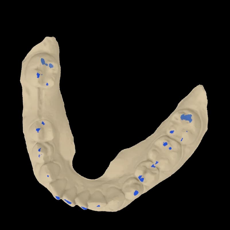 Lower arch with blue contact regions on the chewing surfaces