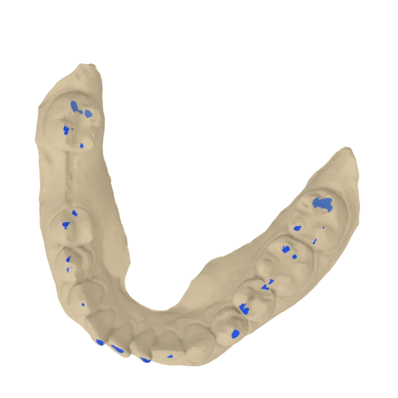 Occlusal view of a lower jaw scan with blue contact spots marking where the arches touch.